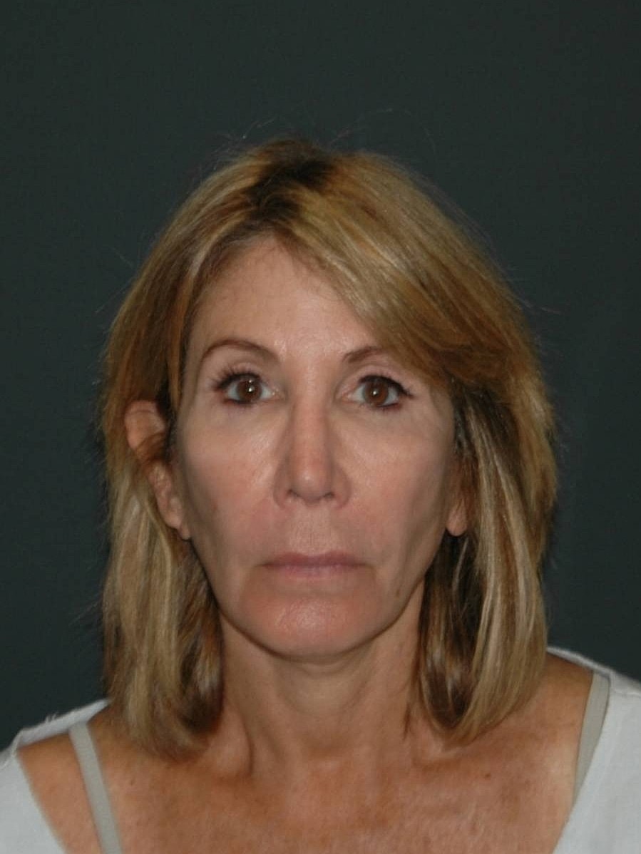 Facelift Neck Lift Before & After
