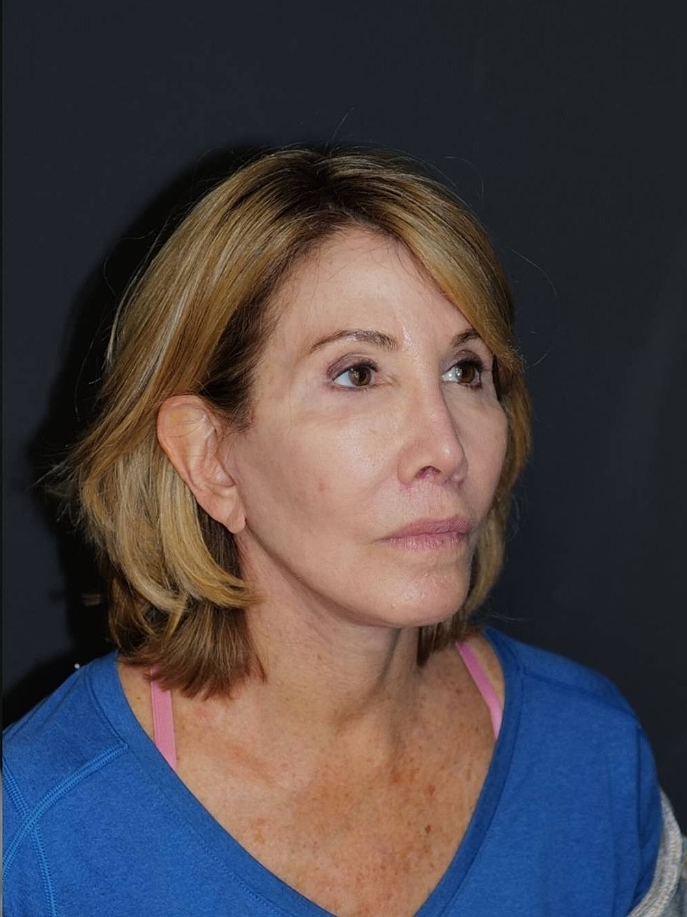 Facelift Neck Lift Before & After
