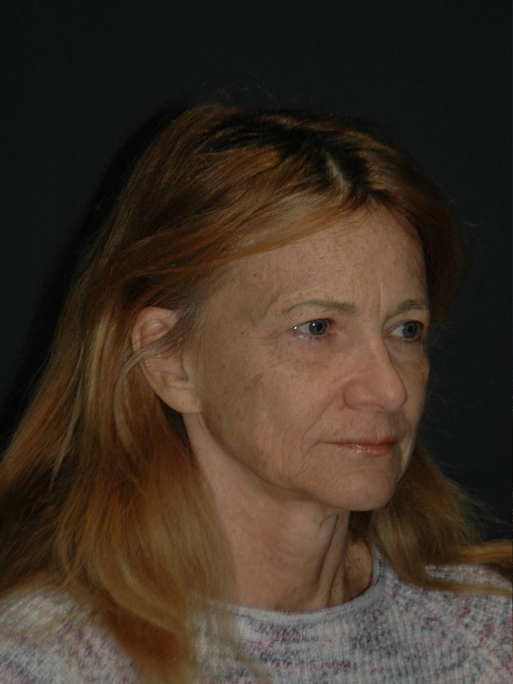 Facelift Neck Lift Before & After