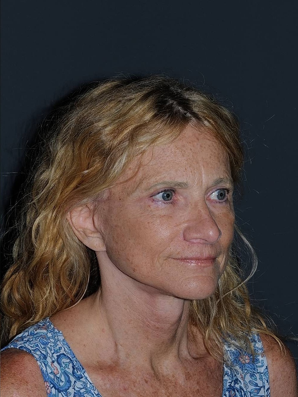 Facelift Neck Lift Before & After