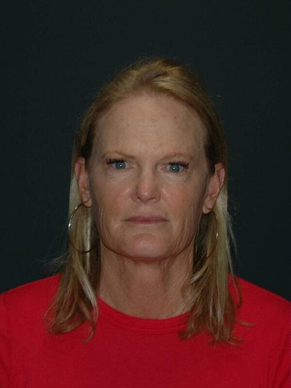 Facelift Neck Lift Before & After