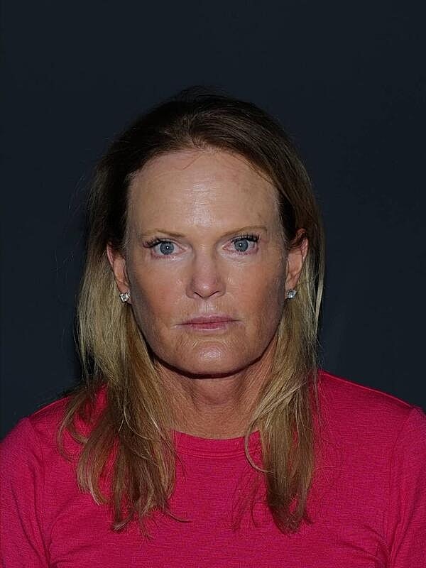 Facelift Neck Lift Before & After