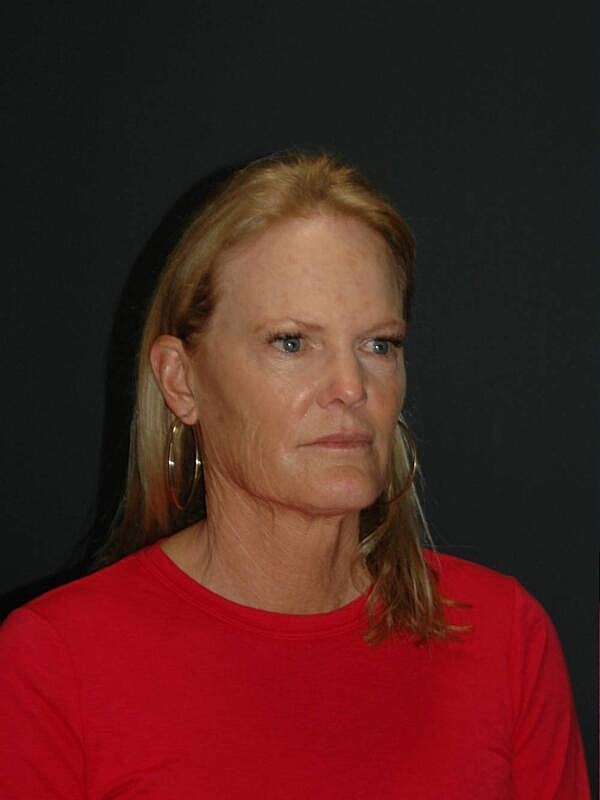 Facelift Neck Lift Before & After