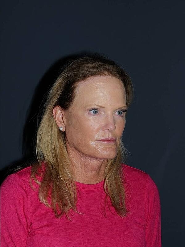 Facelift Neck Lift Before & After