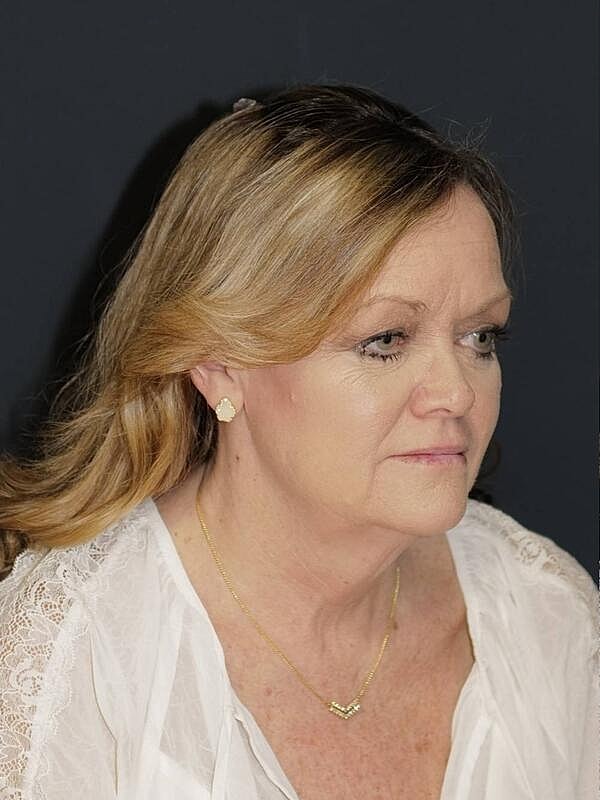 Facelift Neck Lift Before & After