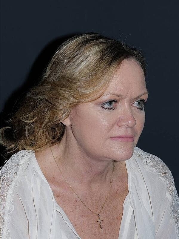Facelift Neck Lift Before & After