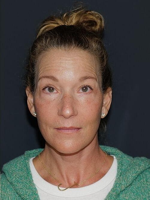 Facelift Neck Lift Before & After