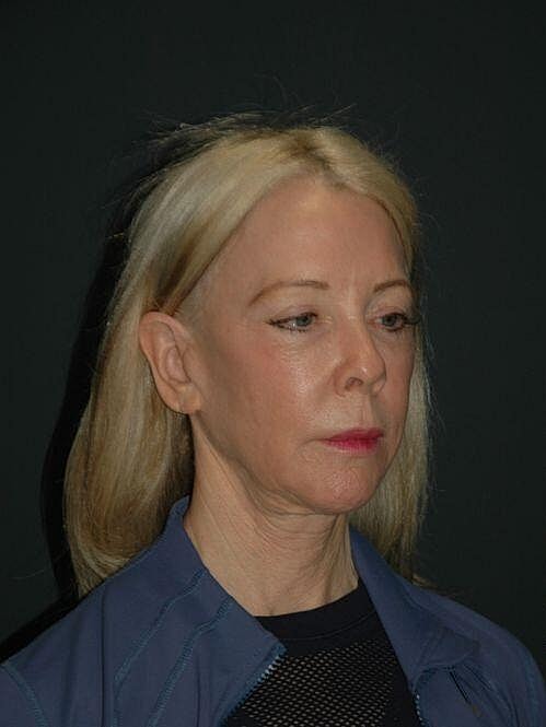 Facelift Neck Lift Before & After