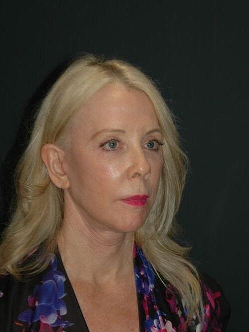 Facelift Neck Lift Before & After