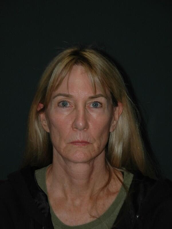 Facelift Neck Lift Before & After