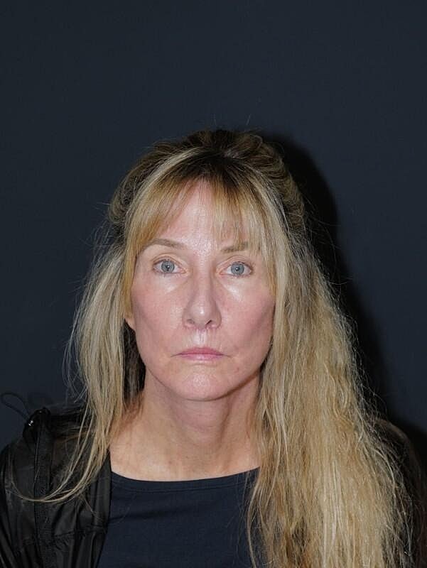 Facelift Neck Lift Before & After