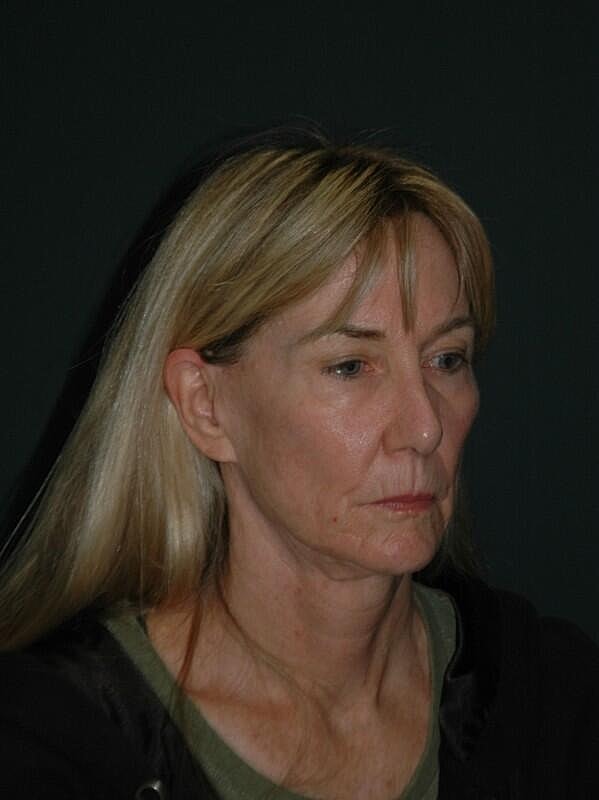 Facelift Neck Lift Before & After