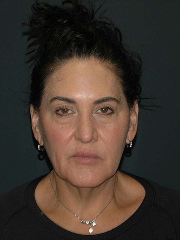 Facelift Neck Lift Before & After