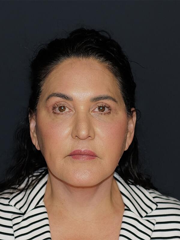 Facelift Neck Lift Before & After