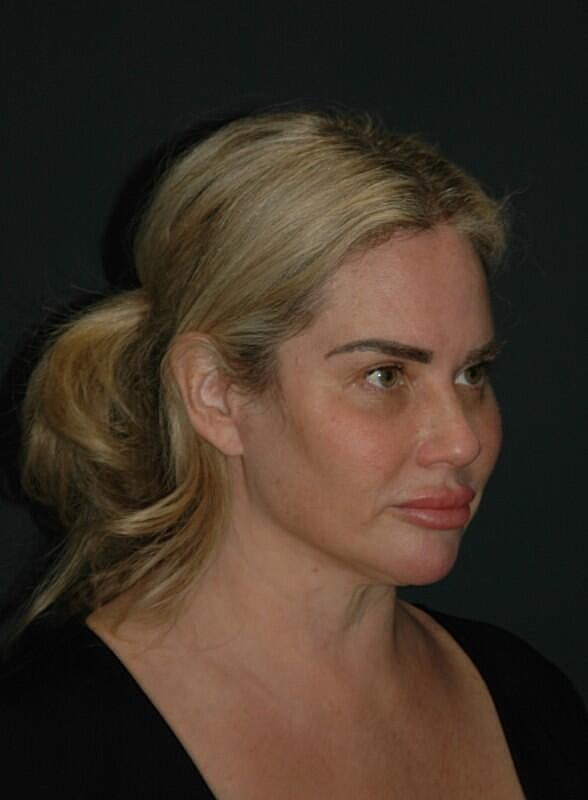 Facelift Neck Lift Before & After