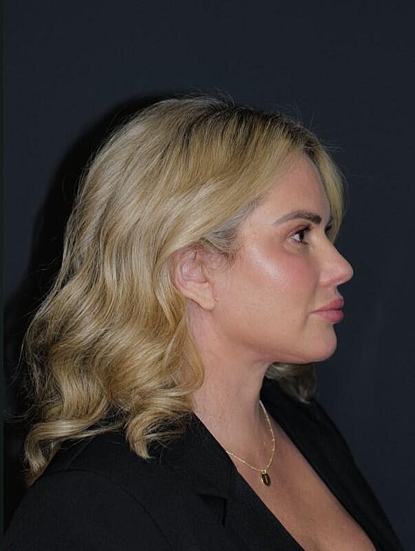 Facelift Neck Lift Before & After