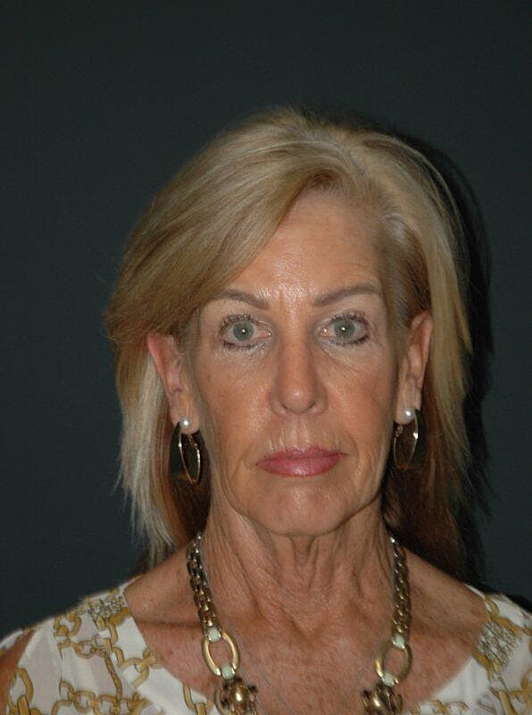 Facelift Neck Lift Before & After