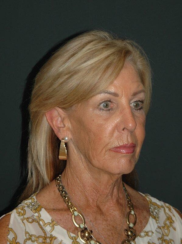 Facelift Neck Lift Before & After