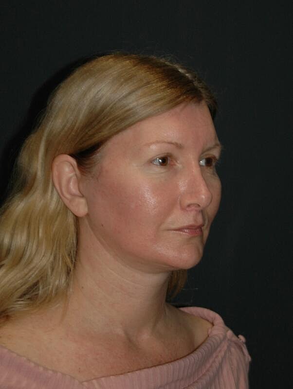 Facelift Neck Lift Before & After