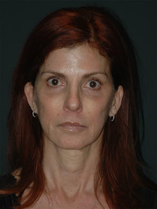 Facelift Neck Lift Before & After