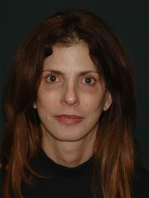 Facelift Neck Lift Before & After