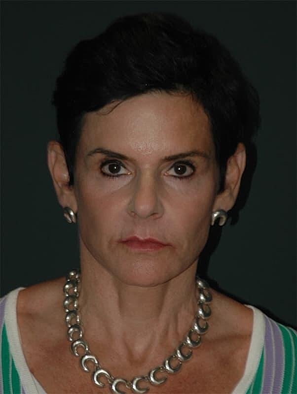 Facelift Neck Lift Before & After