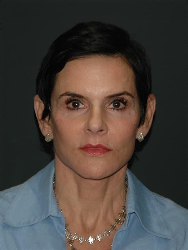 Facelift Neck Lift Before & After