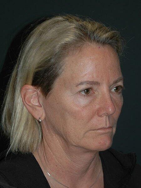 Facelift Neck Lift Before & After