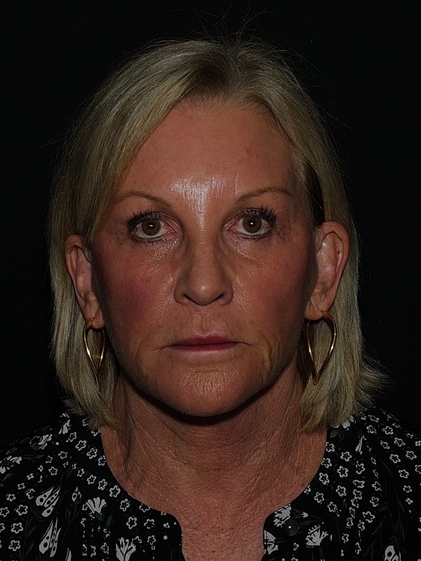 Facelift Neck Lift Before & After