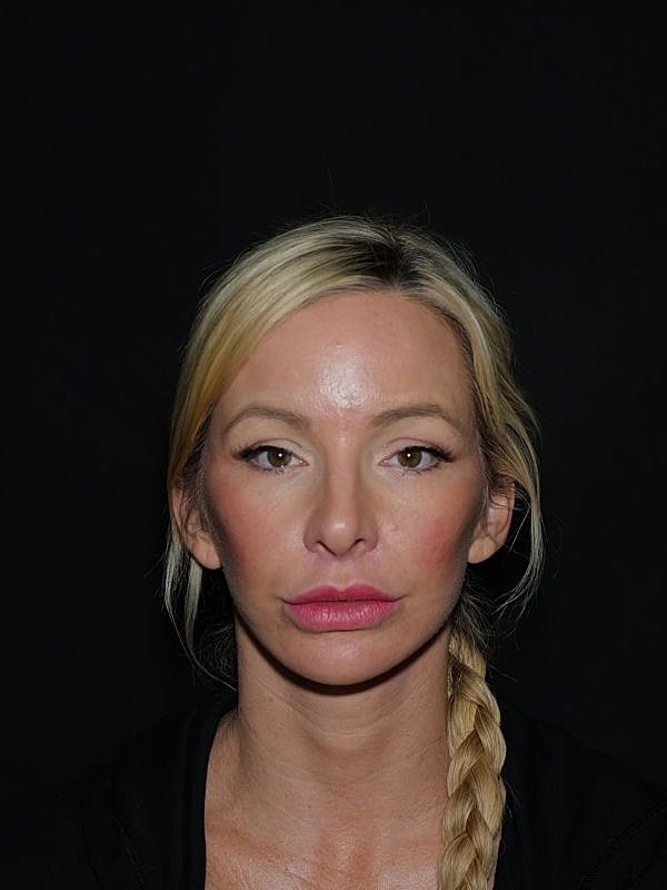 Facelift & Neck Lift Before & After