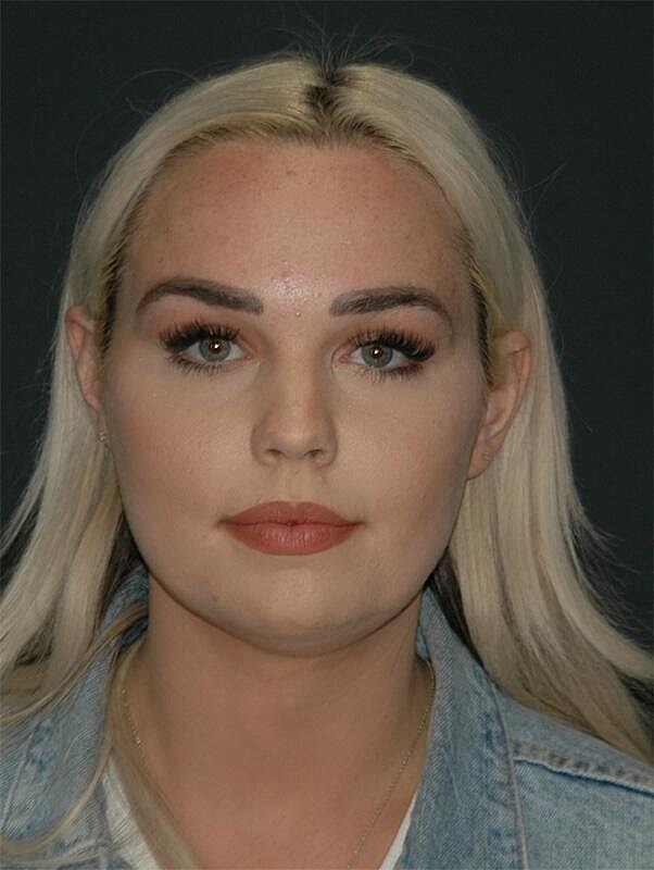 Facelift Before & After