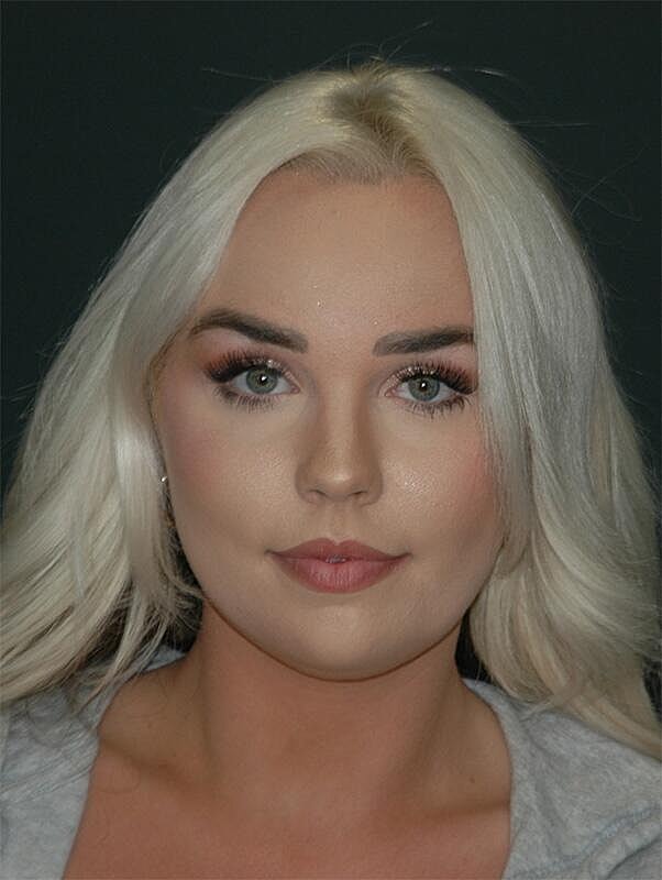 Facelift Before & After