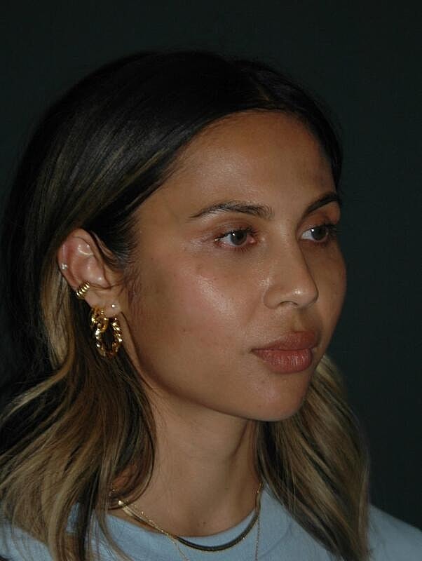 Facelift Before & After