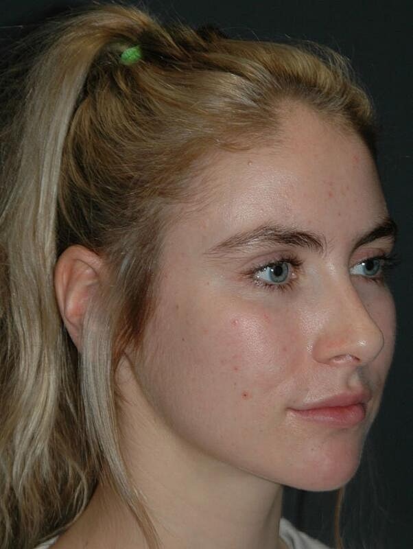 Facelift Before & After