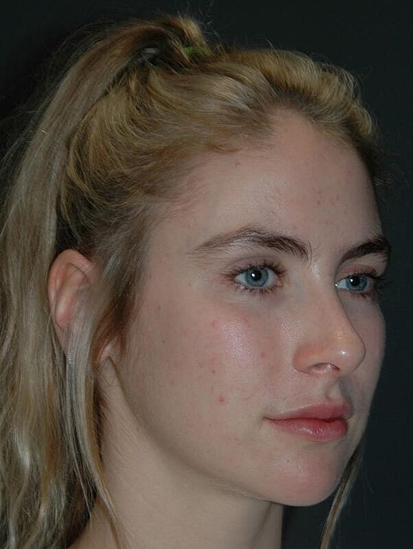 Facelift Before & After