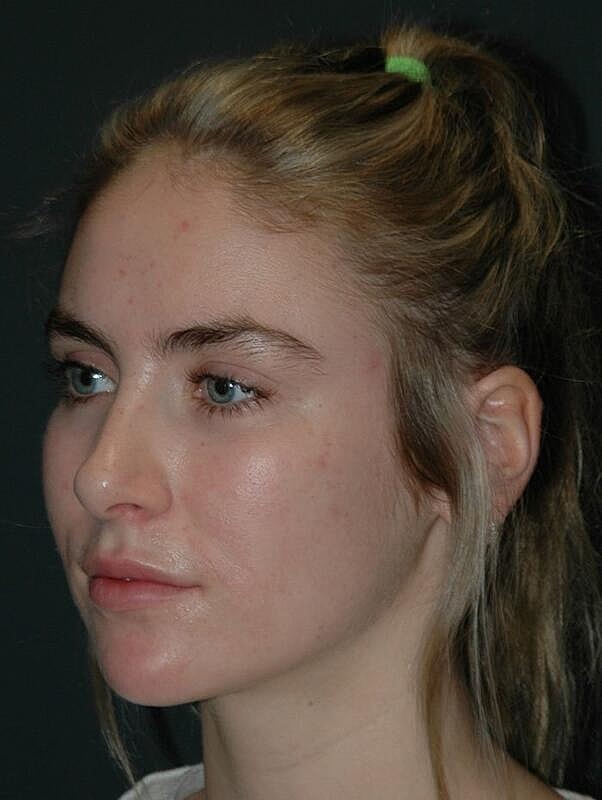 Facelift Before & After
