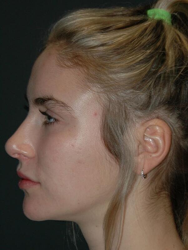 Facelift Before & After