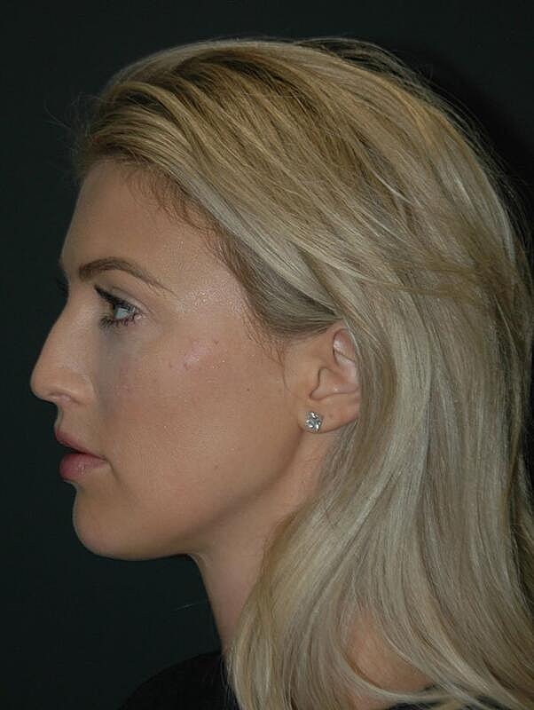 Facelift Before & After