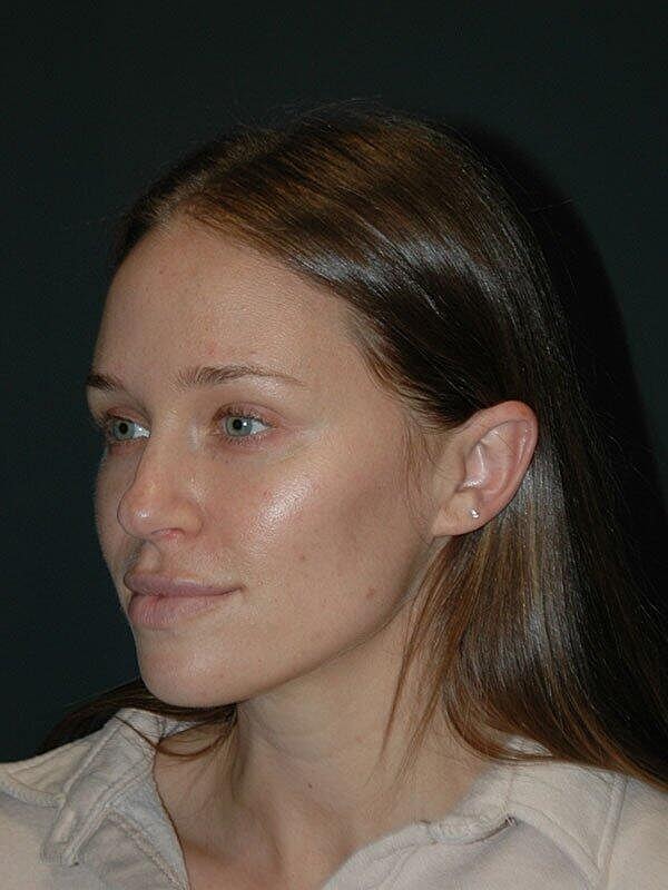 Facelift Before & After