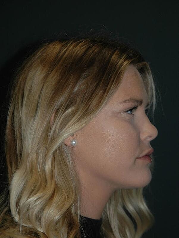 Facelift Before & After