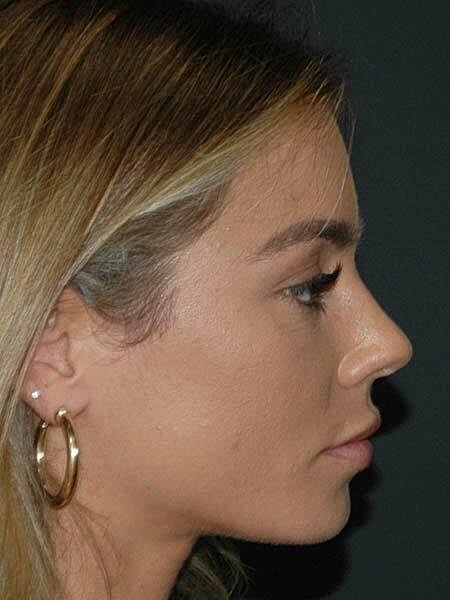 Facelift Before & After