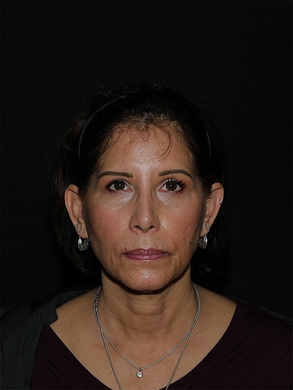 Lip Lift Before & After