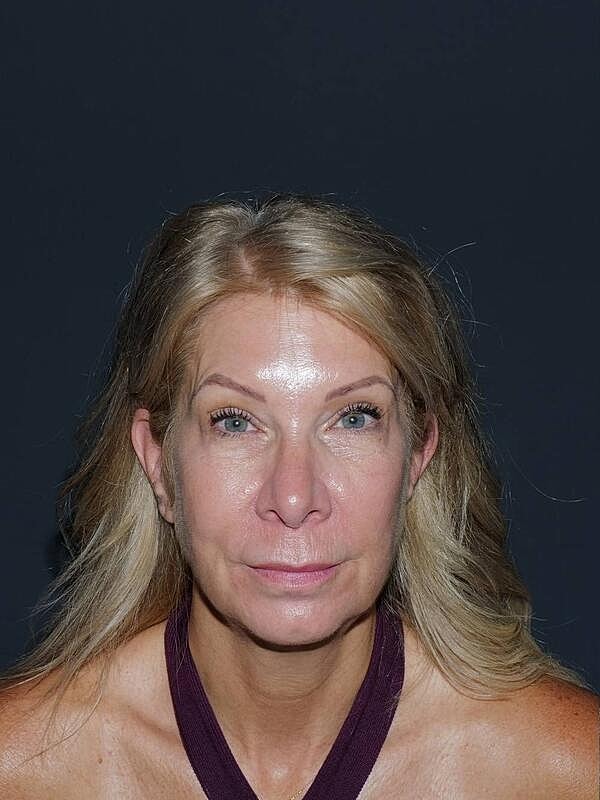Lip Lift Before & After