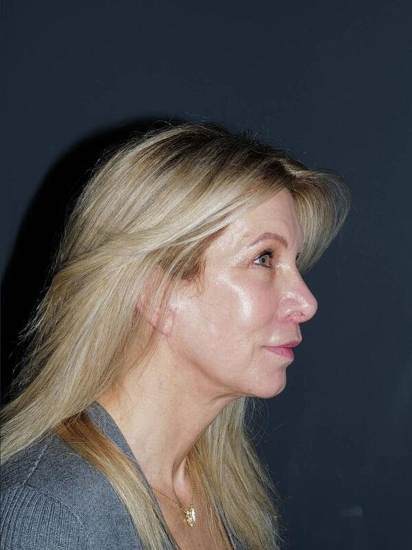 Lip Lift Before & After