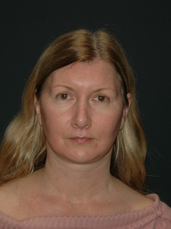 Lip Lift Before & After