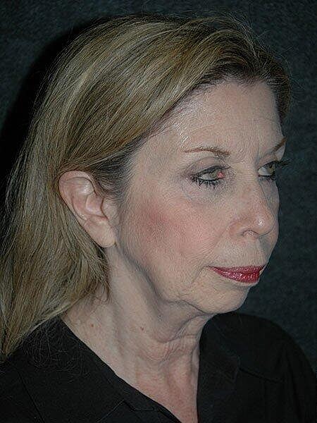 Lip Lift Before & After