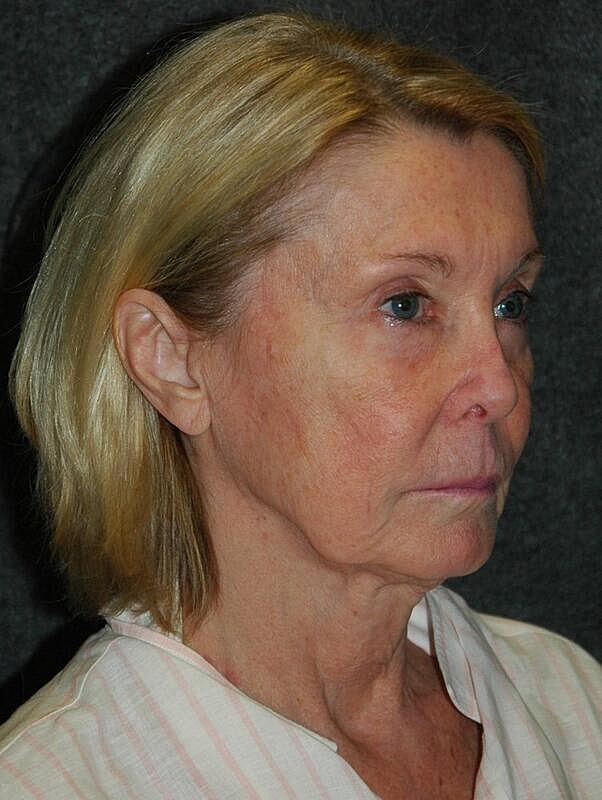 Lip Lift Before & After