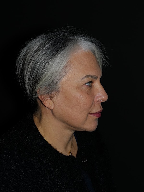 Lip Lift Before & After