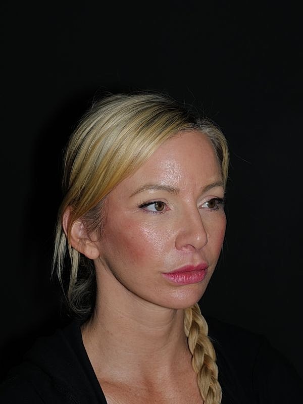 Lip Lift Before & After
