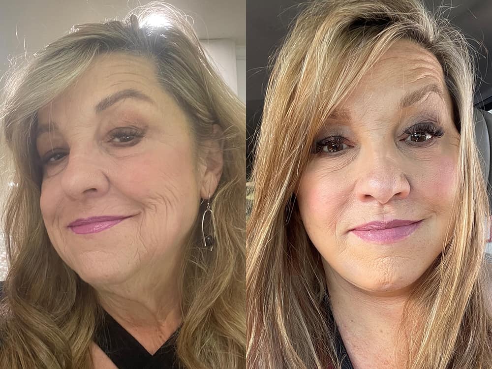 Real patient, Deep Plane Facelift Before and After - Malone Plastic Surgery San Diego